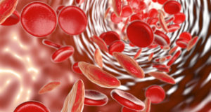 World Sickle Cell Day highlights disease predominantly affecting people of color