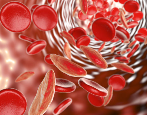 World Sickle Cell Day highlights disease predominantly affecting people of color