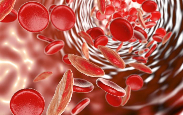 World Sickle Cell Day highlights disease predominantly affecting people of color